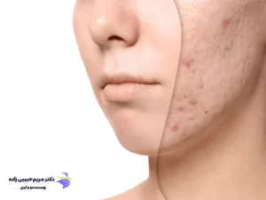 روش های درمان فرورفتگی جای جوش