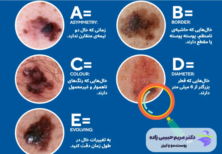 از کجا بفهمیم خال سرطانی است؟